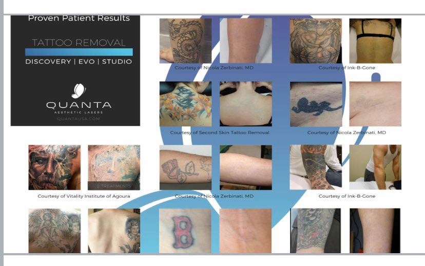 Laser Tattoo Removal  Glow Laser Aesthetics