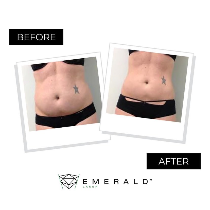 Emerald Body Contouring Glow Laser Aesthetics