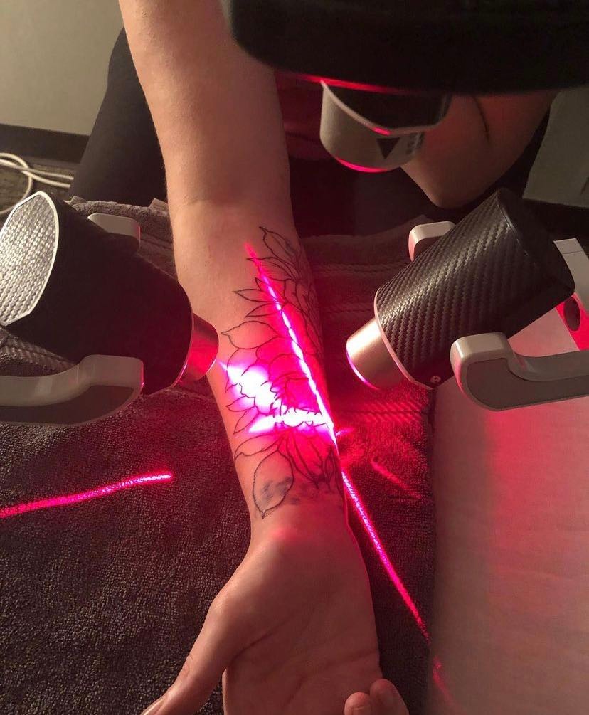 Tattoo Laser 3