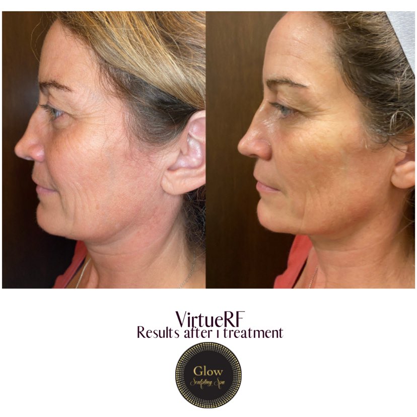 Virtue RF_Before_After_1 treatment