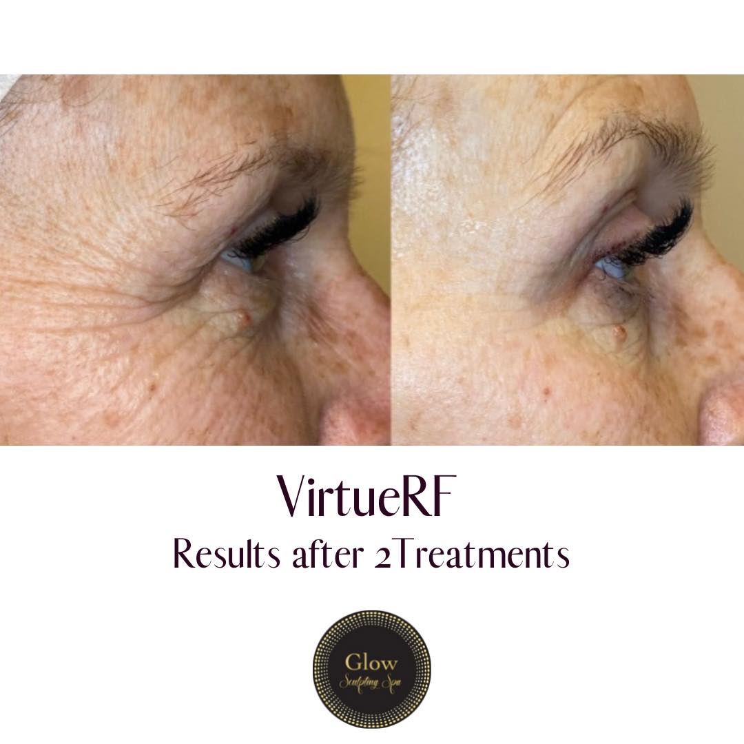 Virtue RF_Results after 1 treatment