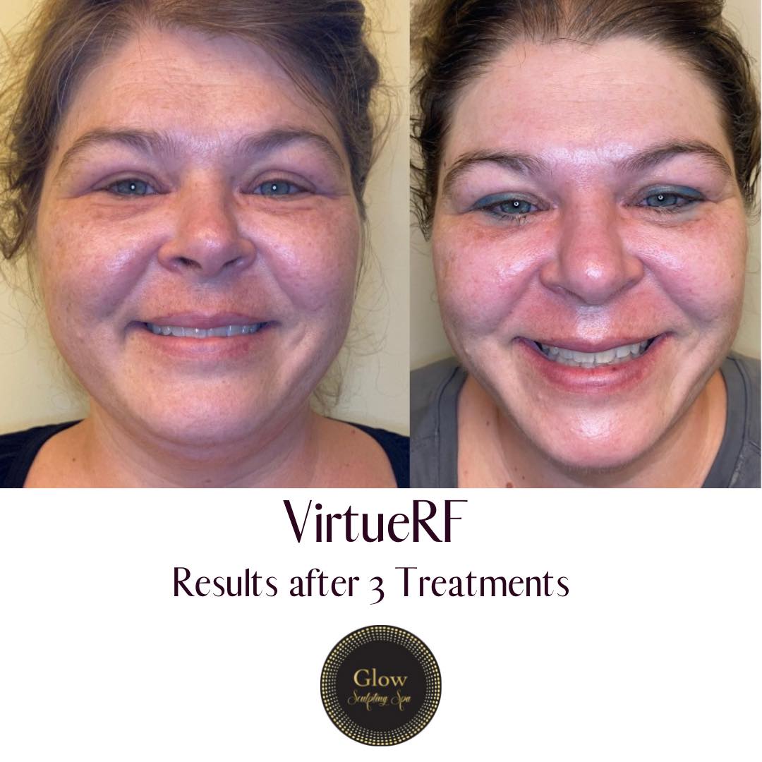 Skin Rejuvenation & Tightening - Virtue RF - Glow Laser Aesthetics