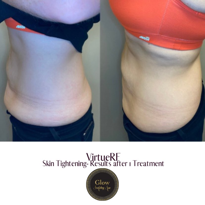 Virtue RF_Skin Tightening results