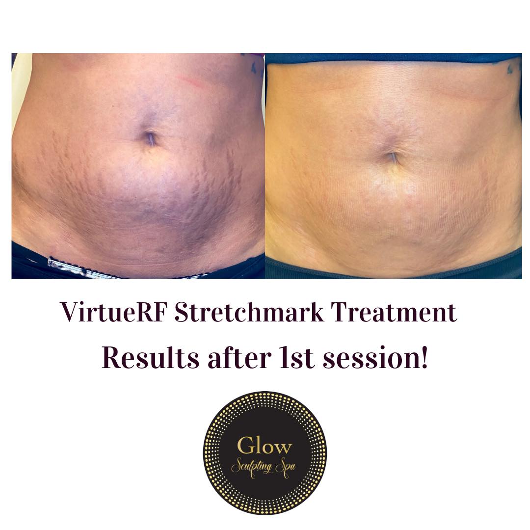 Virtue RF_Stretchmark Treatment